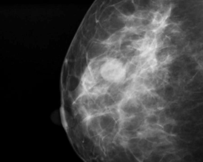 Диагностика мастопатии при климаксе - маммография